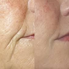 Microneedling Gratis Behandlung Model gesucht