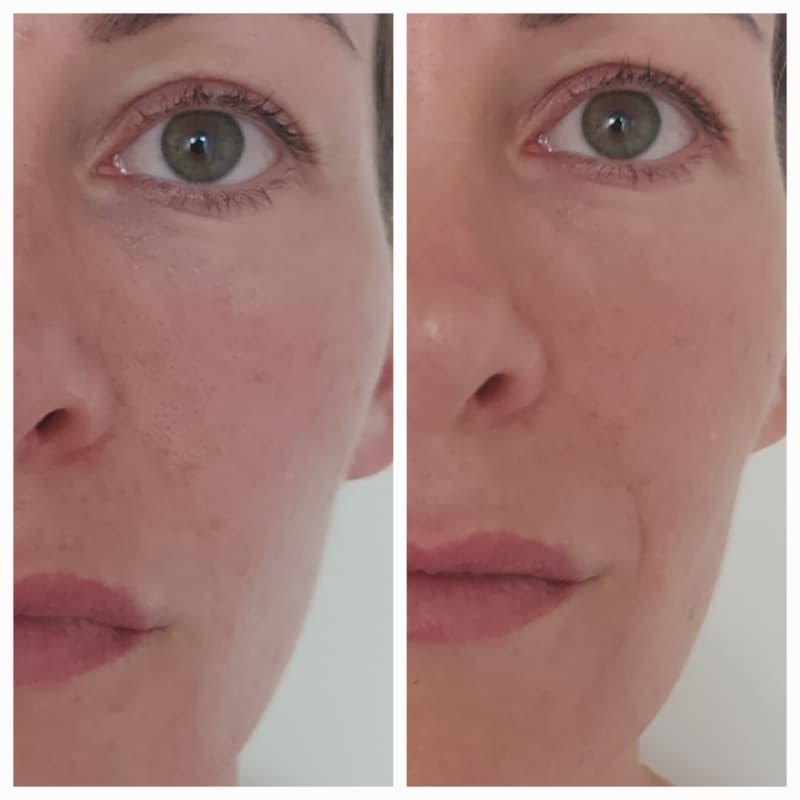 Ergebnisse OHNE FILTER von der ersten GESICHT Behandlung