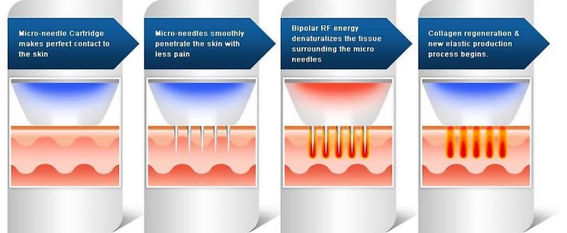 Secret RF - Microneedling Gerät mieten oder Leasingübernahme