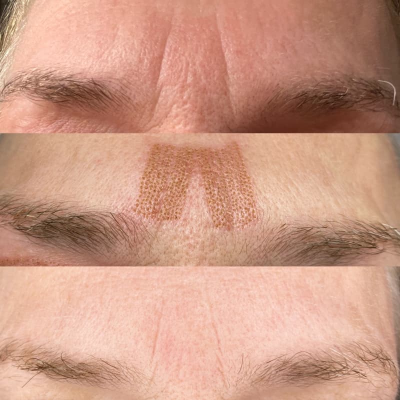 Modelle gesucht für Plasma pen Behandlung
