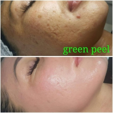 Permanent Make-Up -Mesotherapie/Microneedling/Kryolipolyse 