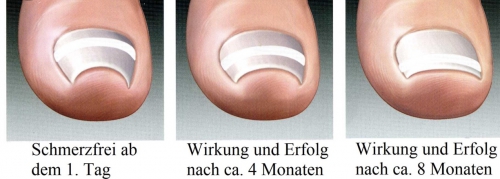 Nagelkorrektur