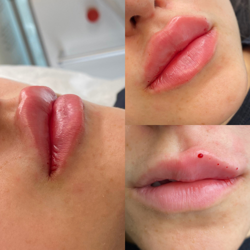 Perkte lippe